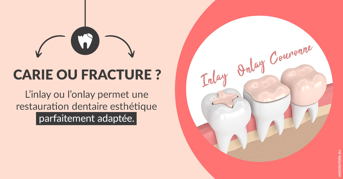https://dr-sebag-leon.chirurgiens-dentistes.fr/T2 2023 - Carie ou fracture 2