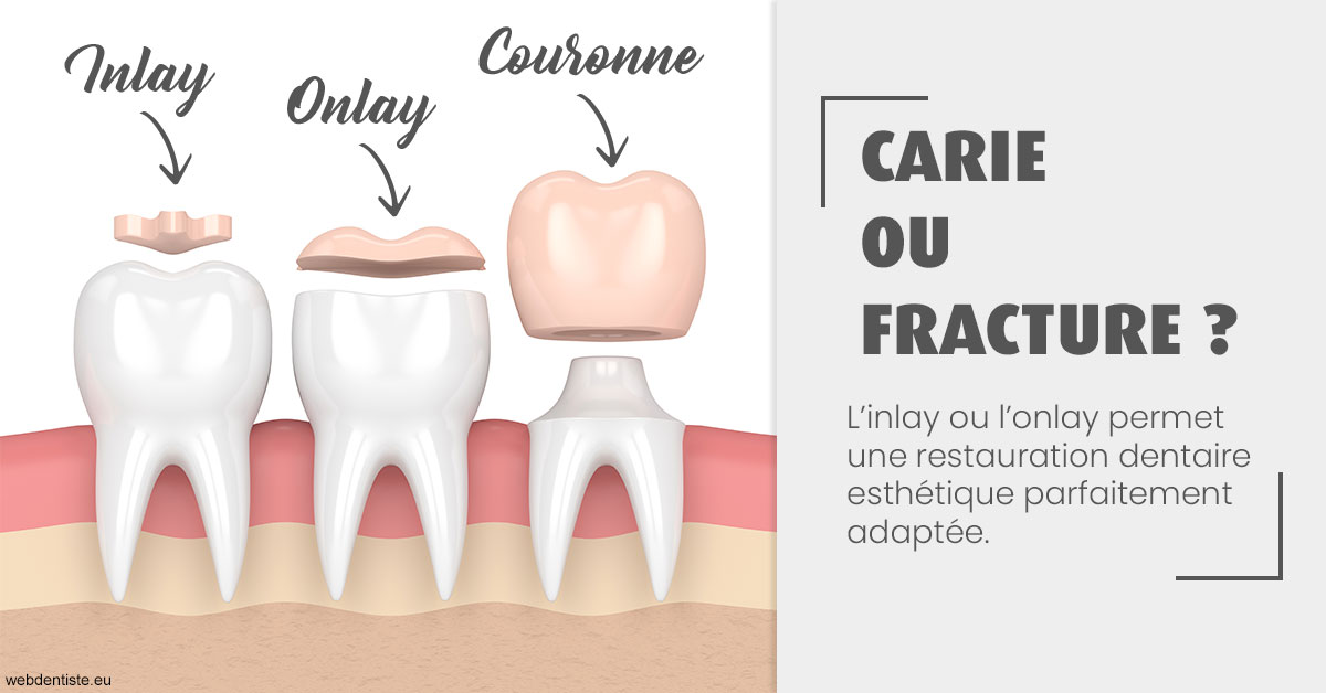 https://dr-sebag-leon.chirurgiens-dentistes.fr/T2 2023 - Carie ou fracture 1
