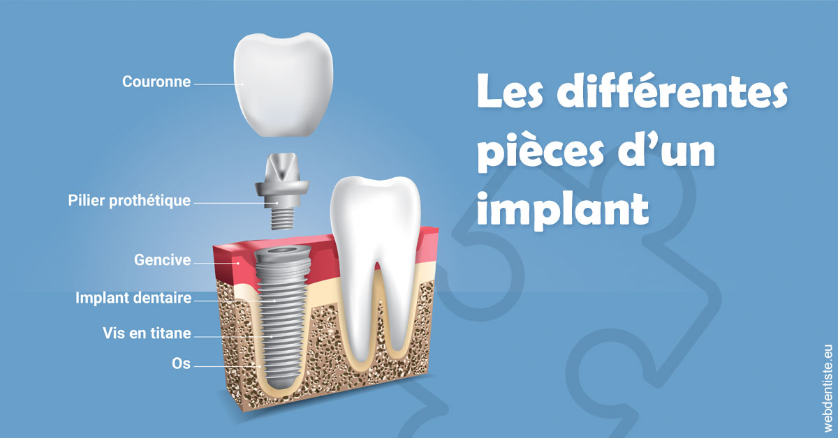 https://dr-sebag-leon.chirurgiens-dentistes.fr/Les différentes pièces d’un implant 1